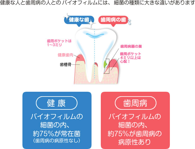 健康な人と歯周病の人とのバイオフィルムには、細菌の種類に大きな違いがあります